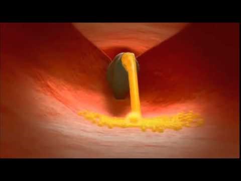 Health Animation - Invitro Fertilisation - 3D