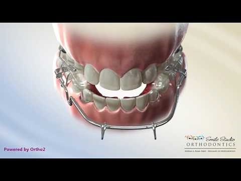 Tandem Appliance - Orthodontic Treatment