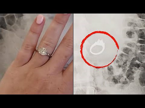 These People Swallowed Some Unusual Objects