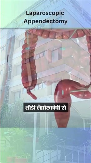 Appendix Surgery Made Safe | Advanced 3D Laparoscopy at Sahaj Hospital