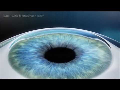 SMILE, Flapless LASIK, Procedure Animation