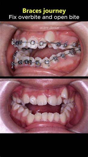 Braces journey: Fix overbite and openbite teeth case #braces #orthodontist #dentist #smilemakeover