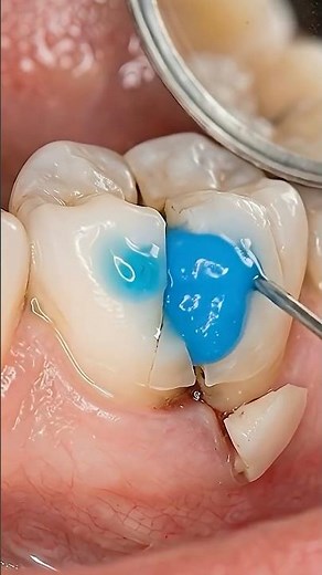 How Dentists Fix a Broken Tooth (Step by Step) 🦷