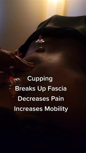 Cupping Therapy...check it out. #cuppingtherapy #massagetherapy