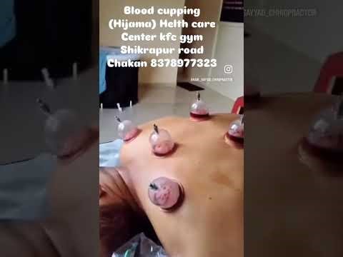 Blood cupping therapy