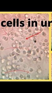 Pus cells in urine | Pus cells in microscope | WBC cells |