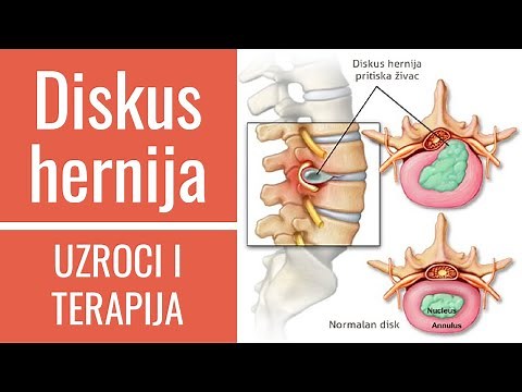Diskus hernija | LIJEČENJE, DIJAGNOSTIKA, SIMPTOMI I UZROCI | dr Gordana Ljoljić Dolić fizijatar