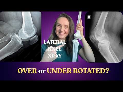 Lateral Knee X Ray: Over or Under Rotated?