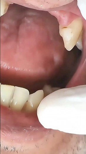 Missing Front Teeth Fixed in One Procedure #dentist #beforeandafter