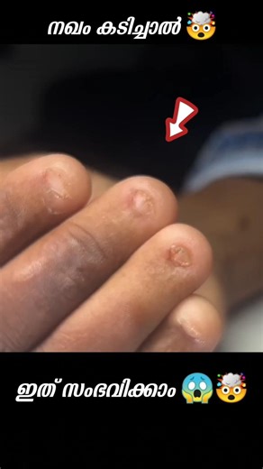 നഖം കടിക്കുന്നവർ ശ്രദ്ധിക്കുക 🤯🔥 #shorts #malayalam