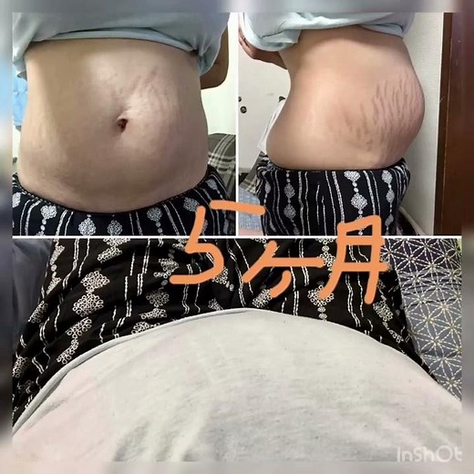 双子が生まれるまでのお腹！