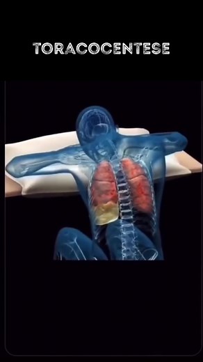 A toracocentese é um procedimento médico utilizado para remover líquido do espaço pleural, que é o espaço entre as membranas que envolvem os pulmões. Essa acumulação de líquido pode ser causada por diversas condições, como insuficiência cardíaca, pneumonia, câncer de pulmão ou doenças hepáticas, entre outras.Durante a toracocentese, o médico insere uma agulha ou um tubo fino através da parede torácica até o espaço pleural e aspira o líquido para fora, aliviando assim a pressão sobre os pulmões e