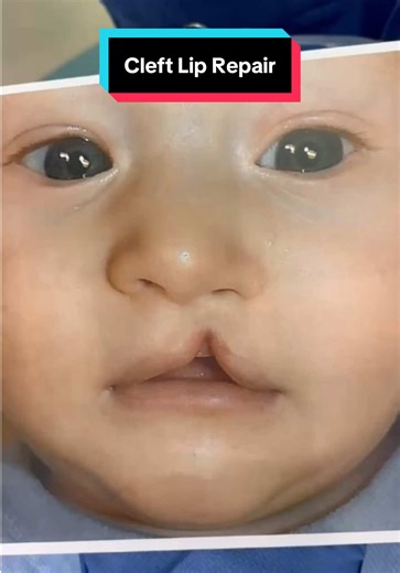 Cleft Lip and Nasal Reconstruction: Before and After
