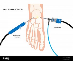 Illustration of an ankle arthroscopy procedure. This is a procedure for diagnosing and treating joint problems. A surgeon inserts a narrow tube attached to a fibre-optic video camera through a small incision Stock Photo - Alamy