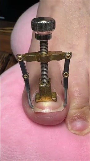 Toe Nail Fixer| Ingrown Toenail Cleaning & Care #ToenailFix #NailCare #FootCare #PedicureClean