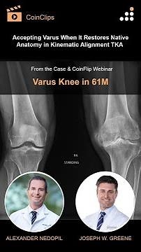 Accepting Varus When It Restores Native Anatomy in Kinematic Alignment TKA