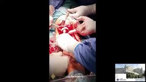 Proximal Tibia Osteosarcoma with Transarticular Femoral Skip Metastases