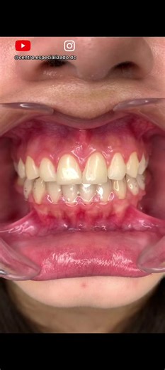 Dental Treatment Process with Clear Aligners