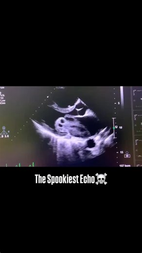 NeuroGen: Your MedSchool BFF on Instagram: "🫀 The Spookiest Echo – Atrial Myxoma in Motion! 🏥 This echocardiographic image reveals a large, mobile atrial myxoma, a primary cardiac tumor with dynamic motion, embolic potential, and hemodynamic consequences. Known as the “great mimicker,” it can present as valvular heart disease, embolic stroke, or systemic inflammatory syndrome. 🔬 Atrial Myxomas: Key Insights 📌 Epidemiology & Origin: • Most common primary cardiac tumor (50-75% of cases) • 75% 
