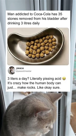 Coca Cola addiction led to bladder stones