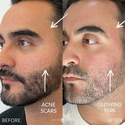 Jason Emer, MD on Instagram: "🔥 ACNE SCAR COMBINATION | PUNCH EXCISION + LASER COMBO ⚡️ My patient had always dreamed of reducing these harsh scars, which made him feel very self-conscious. He wanted to be treated for years but did not trust anyone in Florida to help him because he knew he was a sensitive skin type. He had been following me for some time then came to me as soon as he saw that we visit MIAMI. After one combination treatment, we saw a substantial improvement, but we have a game-p