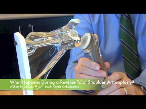 Reverse Total Shoulder Arthroplasty Surgery - Dr. William E. Carlson | South Florida Orthopaedics