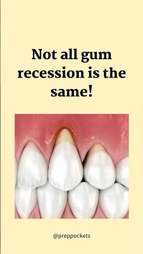 Gum Recession Classification Explained in 20 Secs #dentaltips #dentaleducation #gumrecession #shorts