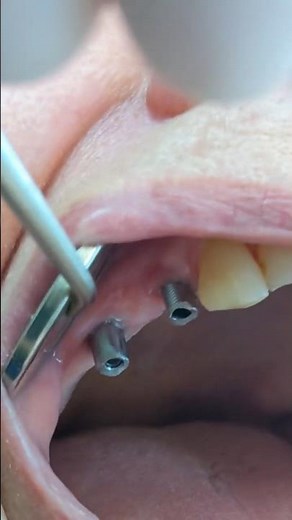 3 tooth implant bridge