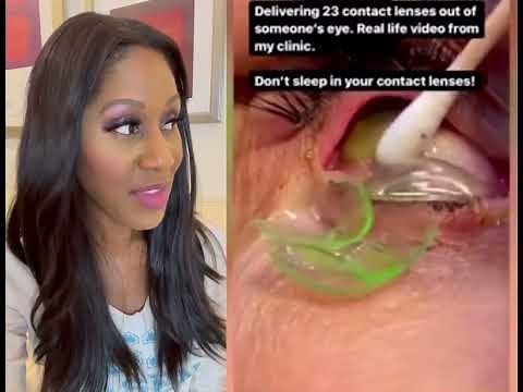 Woman Has 23 Contact Lenses Removed from Her Eye! A Doctor Discusses this Viral Video