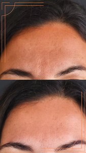 AVANT / APRÈS BOTOX Elle ne cherchait pas à être transformée, elle voulait un coup de boost, un coup de bonne mine! Cette fatigue en bas du visage, ce front un peu trop plissé - ridé, ce reflet — ce n’était pas elle. Quelques injections de Botox, bien placées, et tout a changé. Pas de manière spectaculaire. Mais de manière juste. - Les commissures des lèvres sont légèrement remontées. - Le front est plus lisse, mais garde ses mouvements. - Le regard est plus ouvert. - Et surtout… ce glow. Ce tei