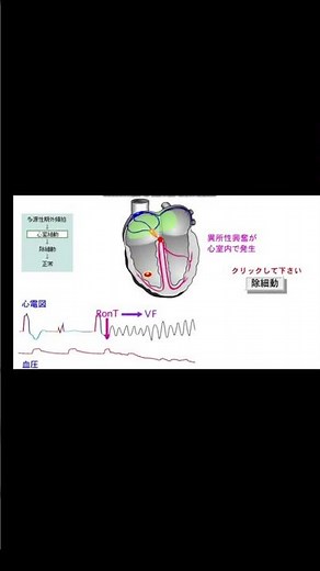 ハート先生Ⓡの心電図セミナー 心室細動
