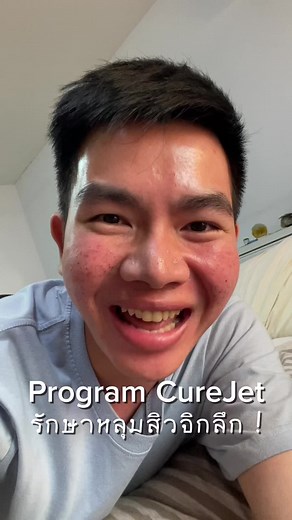 วิธีรักษาหลุมสิวจิกลึกด้วย Program CureJet MicroSubcision