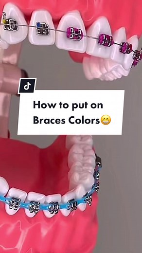 How to Put on Braces Colors: A Complete Guide