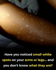 Have you noticed small white spots on your arms or legs… and you don't know what they are? Here's what a specialist says check 1st comment👇 | Feedy Video