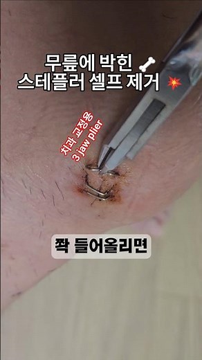 A Dentist's Nerve-Wracking DIY Staple Removal Show (Sterilized) #KneeSurgeryReview #KneeSurgery