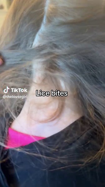 Understanding Rashes at the Nape of the Neck and Lice