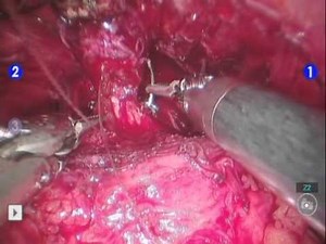Reconstruction Of The Sphincter After Robot-Assisted Radical Prostatectomy • Video • MEDtube.net
