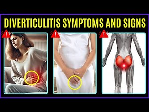 Top 15 Diverticulitis Symptoms (Dont Ignore) | diverticulitis symptoms and signs