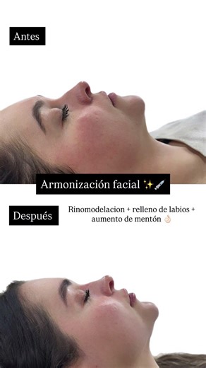✨ Armonización facial completa | Equilibrio del rostro
