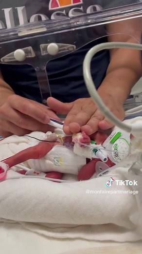 La prématurité … dans l’esprit de certains, c’est une simple naissance avant l’heure. La réalité est bien plus compliquée.11.09.21 - Naissance de nos jumeaux à 27 SA. 590g et 910g. Réanimées à la naissance, ils entament un long parcours pour survivre. « Il y a très peu de chances qu’ils survivent » nous disaient les medecins. Au final mes soldats les ont fait mentir 💪🏼❤️ #premature #bebe #baby #prematurebaby #babies #bebetiktoker #bebeprema
