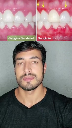 Gengiva Saudável: Causas e Tratamentos