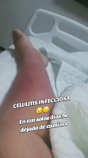 Recuperación de la celulitis infecciosa en piernas