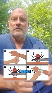 5.6K views · 36 reactions | ER visits for tick bites are reaching record levels this summer  An emergency medicine doctor explains what you should know about removing them safely. #hiking #tick #Insect #nature #lifehack #hike #outdoorsy #tickbite #newjersey #emergencymedicine #emergencyroom #urgentcare #medicaladvice #doctor | Hackensack Meridian Health | Facebook