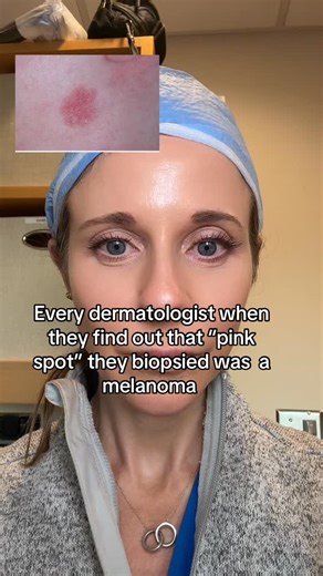 Dr. Abigail Waldman, MD FAAD on Instagram: "Did you know melanoma can be pink, white or skin colored? Amelanotic melanoma has none of the typical pigment that you think of with melanomas, so they are a dermatologist’s worst nightmare. Often they can mimic benign conditions like eczema or less aggressive skin cancers like BCC, but there are often some clues when examined with a small light device called dermoscopy. Follow if you want to catch skin cancer early #melanoma #skincancer #dermatologist