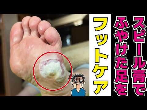 自分で魚の目ケア。スピール膏でふやけた足のケア【ドイツ式フットケア・ウオノメ・タコ】