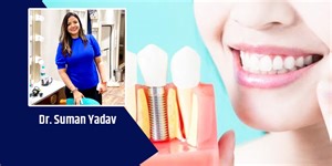 Here's Everything You Need To Know About Dental Implants