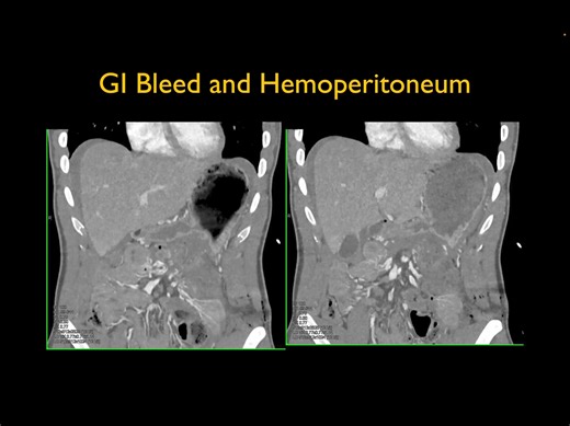 GI Bleed and Hemoperitoneum See the images here: https://ctisus.com/teachingfiles/cases/small-bowel/423106 | CTisus: Cutting edge information on body CT (Computed tomography).