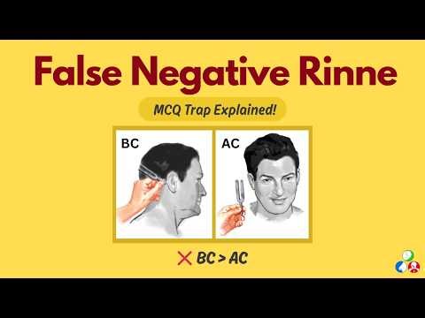 False Negative Rinne Test | MCQ Trap You MUST Know | High Yield ENT Viva & MCQ