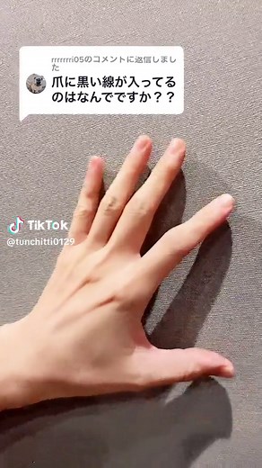 爪の黒い線とメラノーマの見分け方