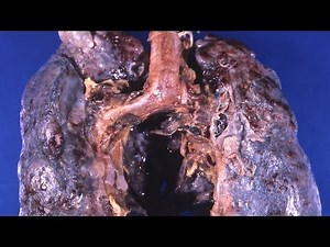 Emphysema. Symptoms and treatment of COPD